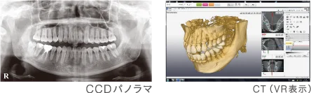 西川歯科医院　CT購入いたしました　親しらず　根管治療　マイクロスコープ