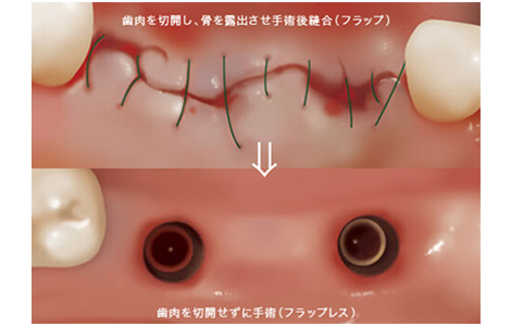 フラップレス手術（無切開手術）