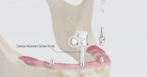 Implants開設動画
